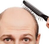 Лечение облысения средствами против выпадения волос