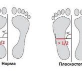 Плоскостопие: Виды
