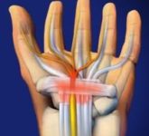 синдром кистевого туннеля