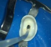 Как проводится инструментальная обработка корневых каналов буравами и дрильборами при периодонтите