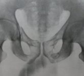 Рентгенодиагностика перелома переднего тазового полукольца у взрослых и детей