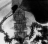Стеноз начальной части двенадцатиперстной кишки: причины и рентгенографическая картина