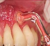 Лечение стоматита