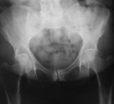 Перелом таза по Мальгеню с переломом поперечного отростка и его диагностика