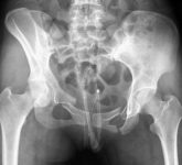 Перелом костей таза с разрывом мочевого пузыря на рентгенограмме