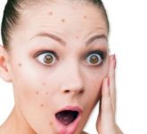 Причины появления прыщей и способы избавления от них