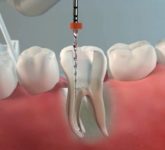 Инструментальная обработка канала корня зуба