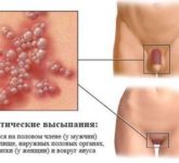 Герпес в интимном месте
