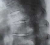 Повреждения 4 грудного позвонка и их рентгенодиагностика