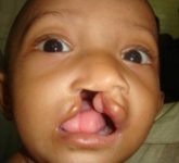 Врожденные пороки развития и уродства