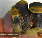 Лечение травматических некрозов