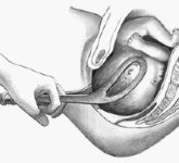 Показаний со стороны роженицы к наложению акушерских щипцов