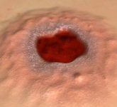 Мягкий шанкр - венерическое заболевание, вызываемое Hämophilus ducreyi