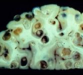 Цистицерк в головном мозгу