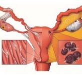 Генитальный туберкулез у женщин - причина диагностических ошибок