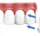 Критерии и принципы восстановления коронок зубов