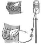 Промывание мочевого пузыря