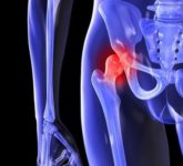 Периартроз тазобедренных суставов: лечение боли блокадой