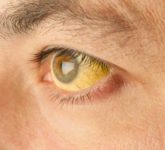 Лечебно-диагностическая тактика при механической желтухе