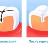 Герметизация фиссур и ямок зубов