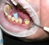 Противопоказания к резекции корня и гемисекции зуба