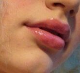 Увеличение губ