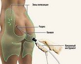 Виды липосакции