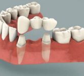 Особенности и преимущества несъемного протезирования зубов