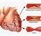 Ишемическая болезнь сердца