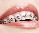 Способы исправления прикуса