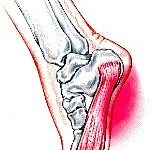 Подошвенный фасциит