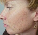 Что такое лентиго