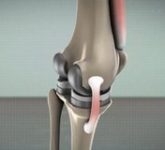 Показания к эндопротезированию коленного сустава 