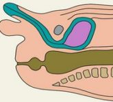 Анальный стеноз