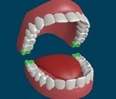 Зубы мудрости