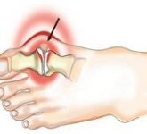 Общие сведения о подагре