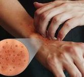 Кратко о нейродермите