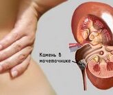 Методы лечении мочекаменной болезни