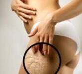 Лечение растяжек с помощью мумиё