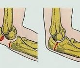 Перелом в локтевом суставе