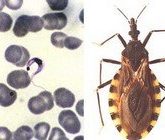 Болезнь Чагаса (Американский трипаносомоз)