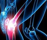 Лечение артрита народными способами