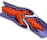 Народные средства в лечении флебита