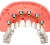 О зубных протезах простыми словами