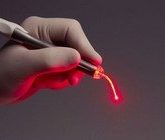 Лечение зуба лазером