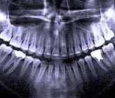 О рентгене зубов