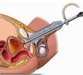 Описание ТУР-синдрома