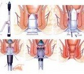 Лечение геморроя посредством операции Лонго