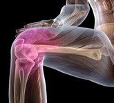 Злокачественная фибросаркома