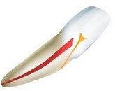 Осложнения препарирования - перфорация полости зуба